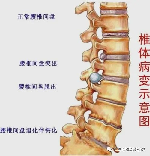 腰椎间盘突出疼痛点图图片