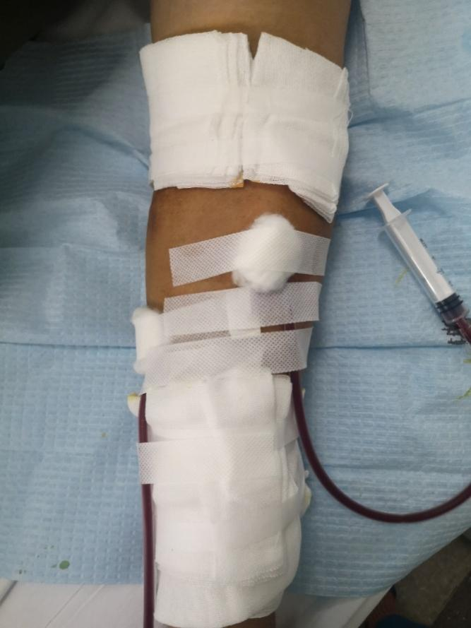 齐鲁医院青岛院区肾内科完成首例血液透析人工血管内瘘手术