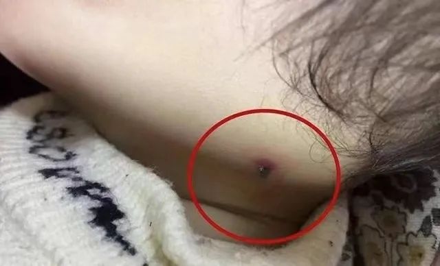 同樣被蚊子咬大腫包代表身體虛小紅點說明身體好