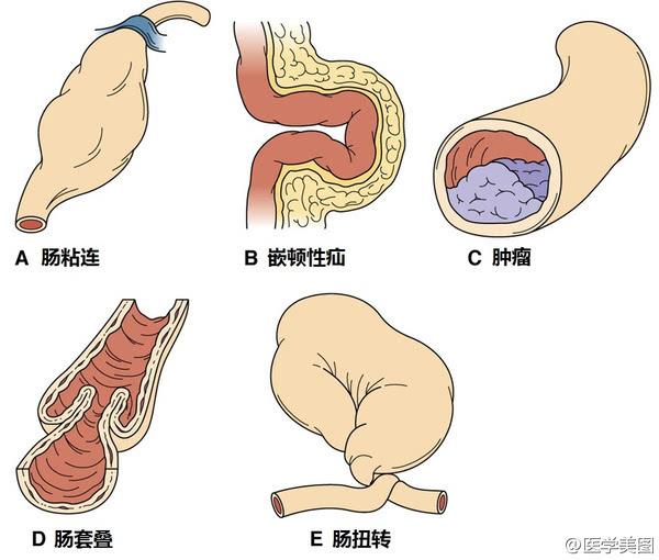 肠梗阻顾名思义就是肠内容物在肠道内发生拥堵,不能顺利通过,继而