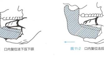 口水顺着嘴角流下来，在疼痛下，我的脸丑成了一个“囧”字