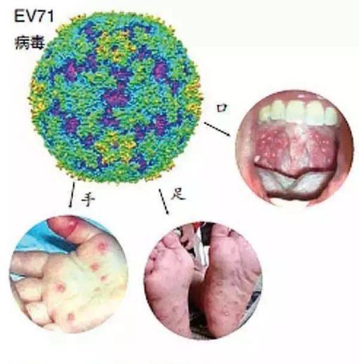 健康不放假暑假當心手足口和皰疹性咽峽炎