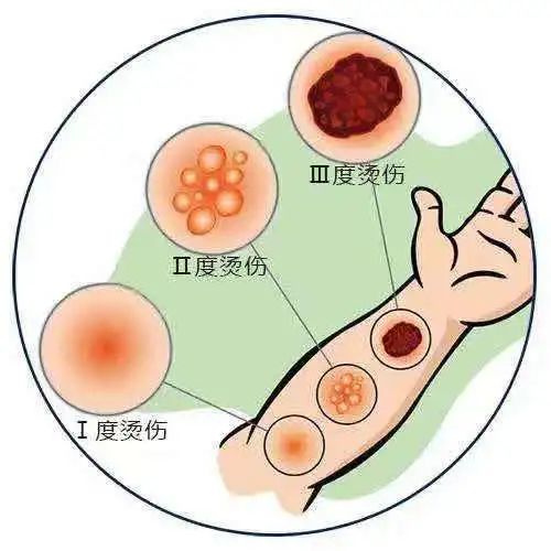 听说有人在伤口处抹酱xiā油zhěng