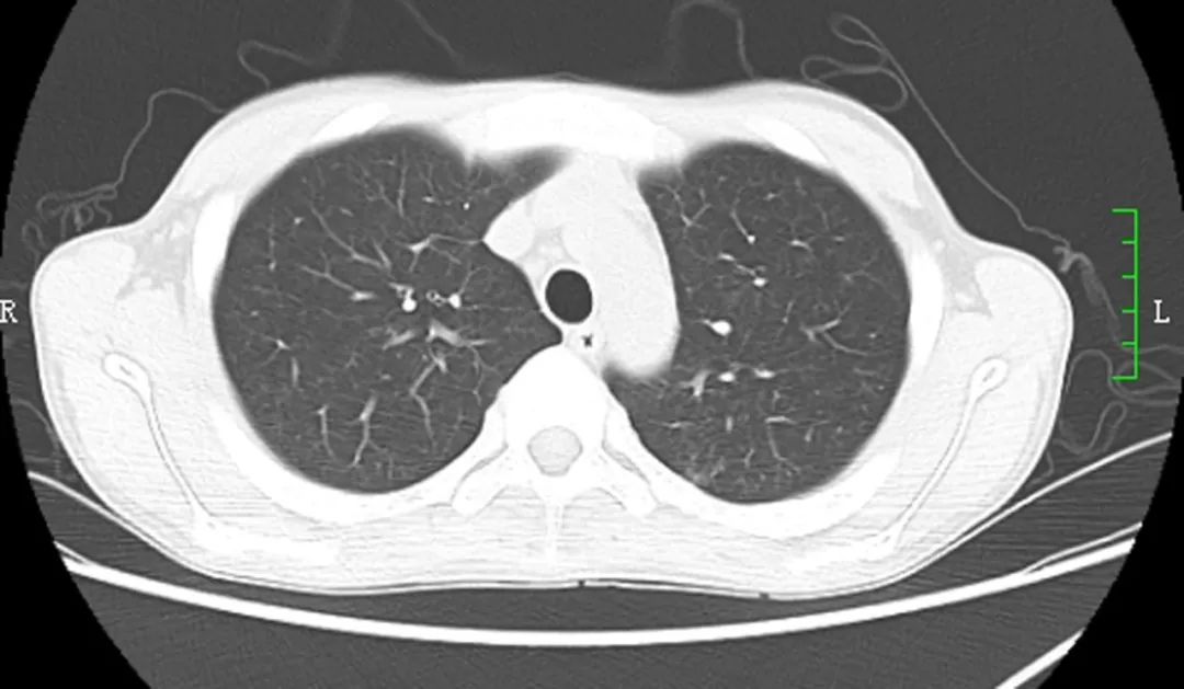 正常人肺部ct图片