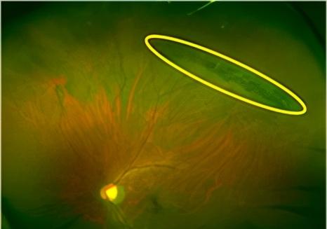 视网膜格子样变性视网膜出血是指血视网膜内外屏障的损坏,导致毛细