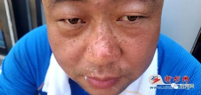 一直在水里转运人员,水面折射阳光比地面严重,队员的脸被晒伤了.