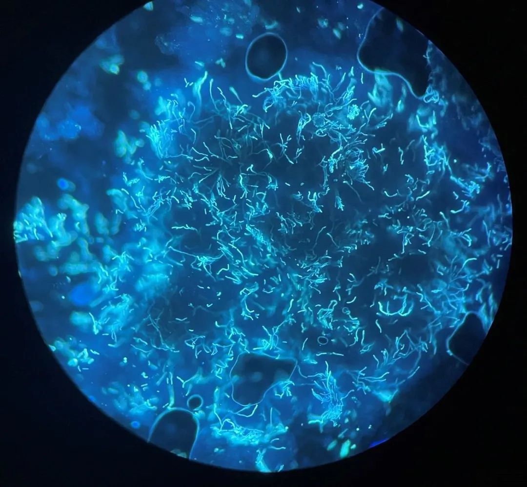 夏日炎炎汗斑莫猖獗