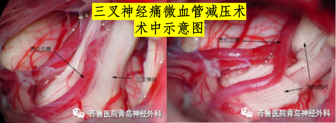 根治神经性头疼_治疗头疼神经病_神经性偏头痛怎么治疗才能根治