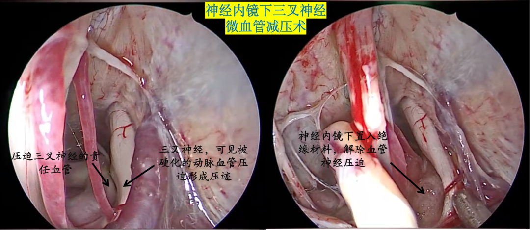 山東大學齊魯醫院(青島)神經外科多項技術全面阻擊三叉神經痛