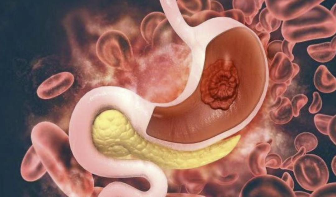 胃龄竟然与胃癌有关你的胃龄有多大