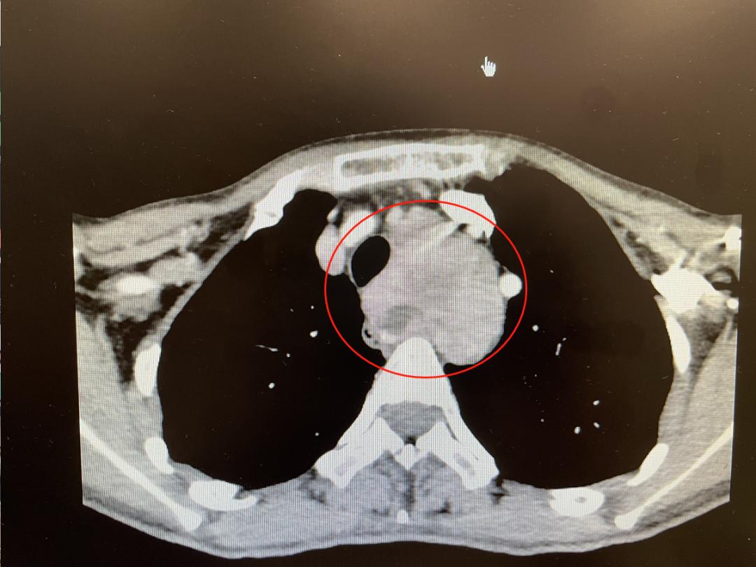 胸外科李鹤成主任以及杭钧彪,车嘉铭等专家讨论认为,患者纵隔后肿物