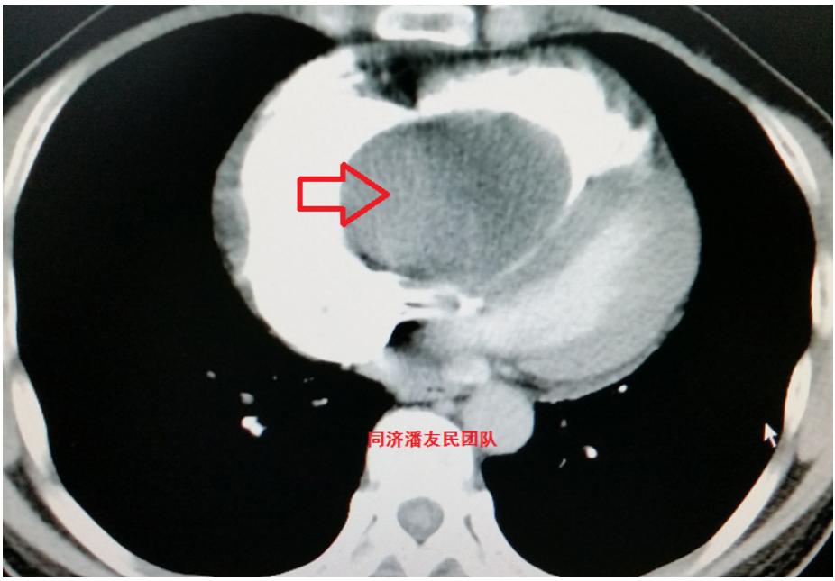 以为心塞不是病?可能是心脏黏液瘤