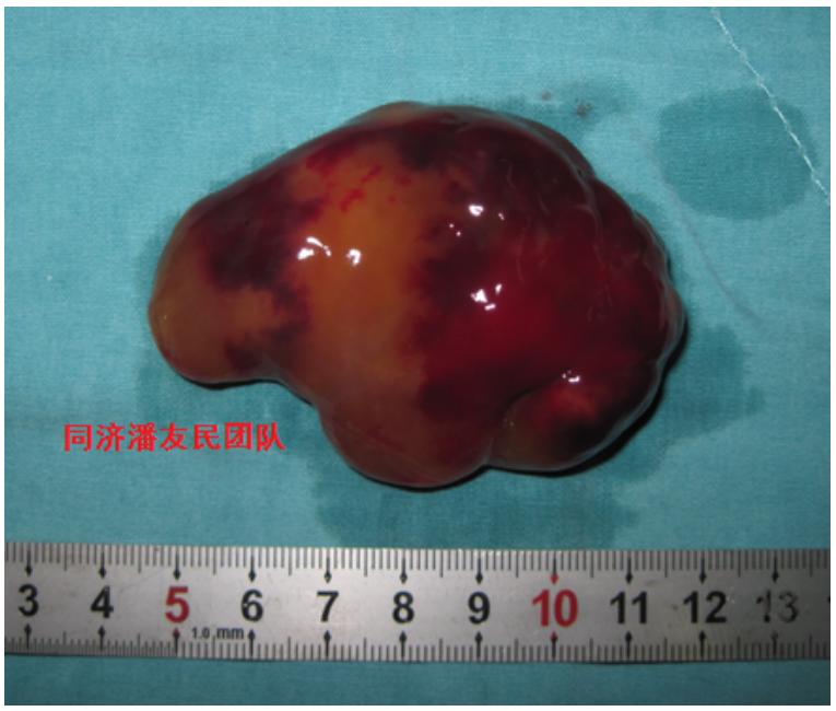 醫學界心血管頻道視頻2 mri顯示的左房粘液瘤 心臟黏液瘤的治療 心臟