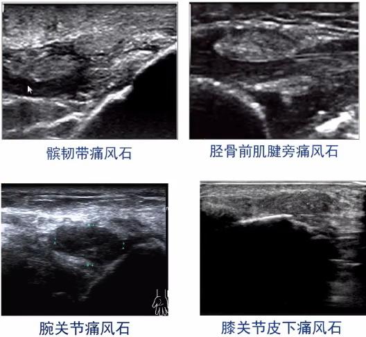 痛风肾超声图片图片