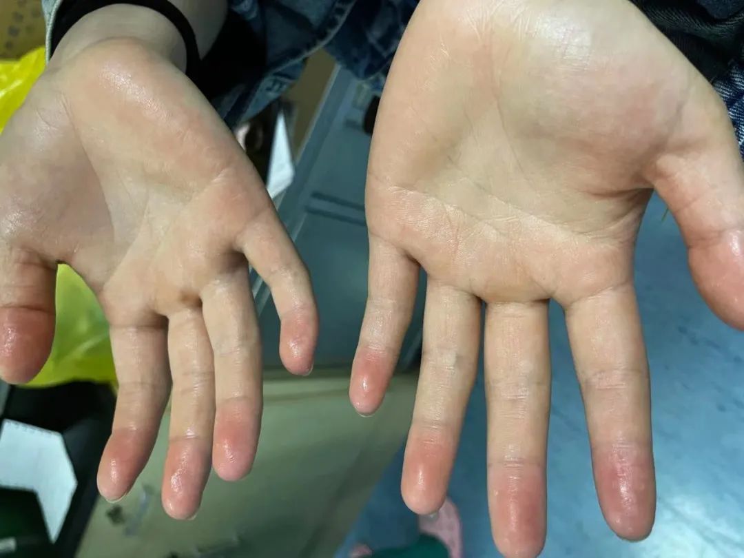 特色门诊疼痛门诊告诉你手老出汗可能是病