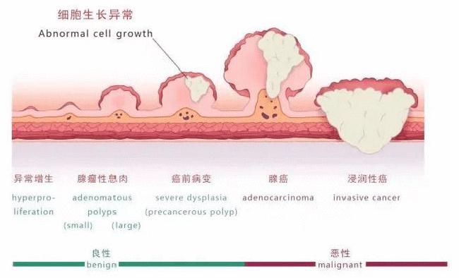 山海提升浙醫嵊泗分院駐院專家內鏡下摘除巨大結腸息肉