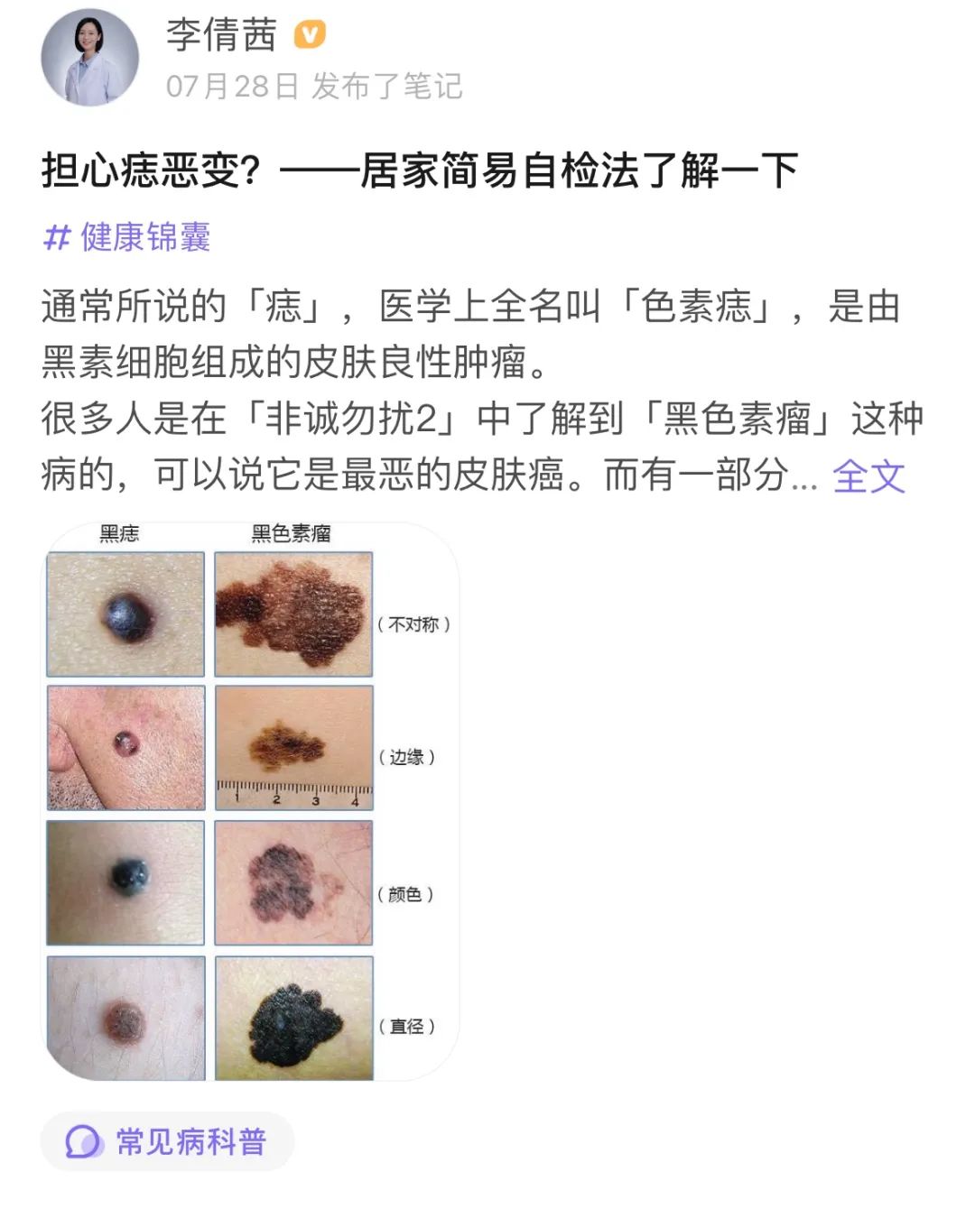 痣有这5种特征可能会恶变一旦发现要当心