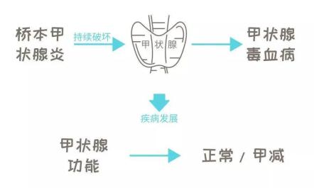 健康百科教您正確認識橋本氏甲狀腺炎