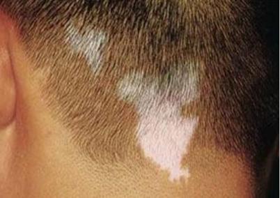 我家宝宝不到3岁就"少白头"了,怎么回事?