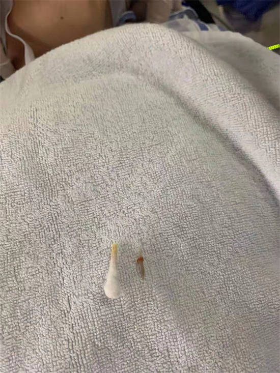 全麻后为什么送icu喝一碗鸡汤被骨头卡住 25岁姑娘连夜被送进icu_https://www.jmylbn.com_新闻资讯_第1张