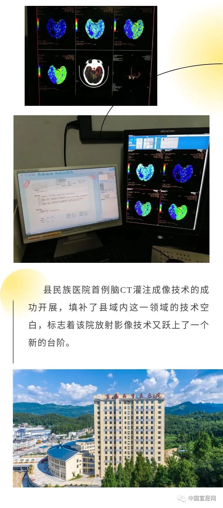 宣恩县民族医院成功开展ct灌注成像检查
