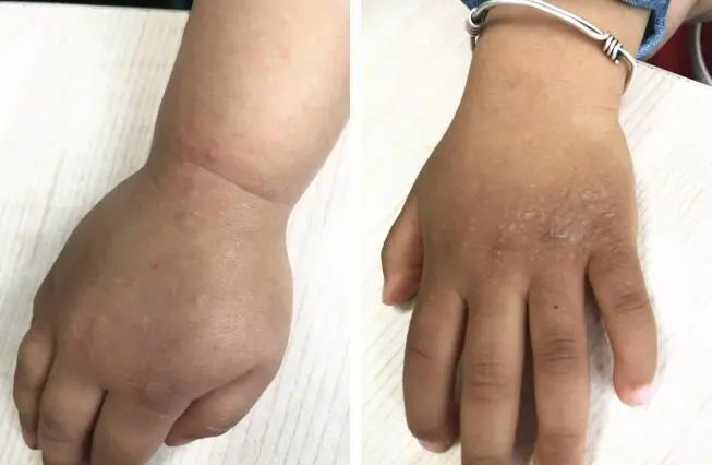 炎炎夏日河边玩沙也会得病这种皮肤病好发于210岁儿童