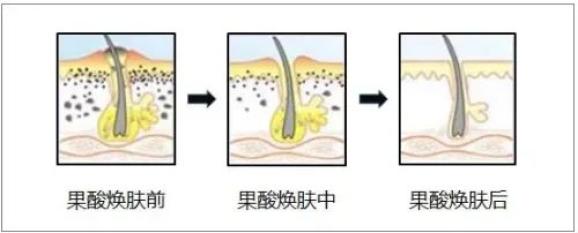 金醫健康果酸換膚你想知道的這裡都有