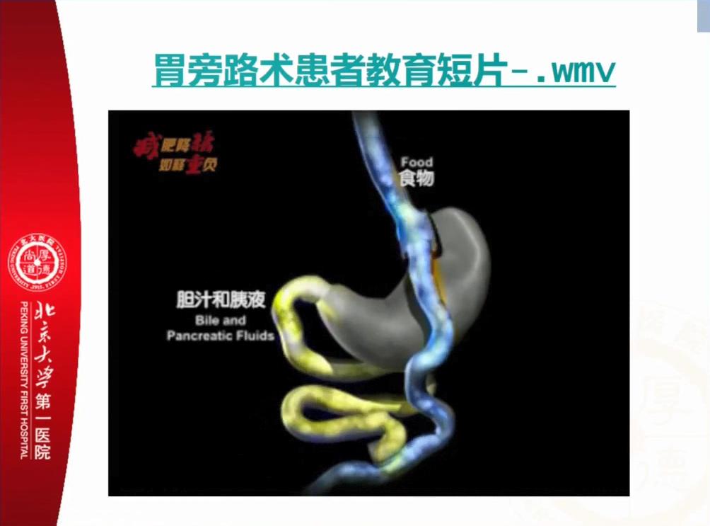 减肥手术多少多钱_手术减肥_减肥手术哪种方式最佳