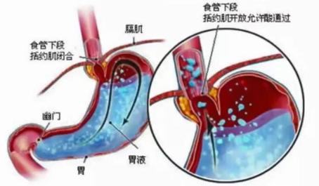 手术减肥_减肥手术多少多钱_减肥手术哪种方式最佳