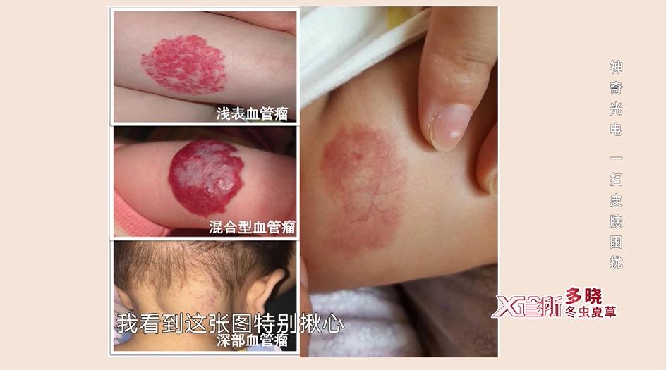 有些宝宝的血管瘤会慢慢消褪,但有些宝宝的血管瘤在1岁以内会疯狂生长