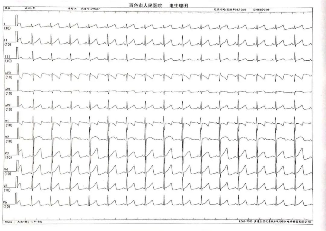 重获心生百色市人民医院实施零射线射频消融术巧除患儿心病