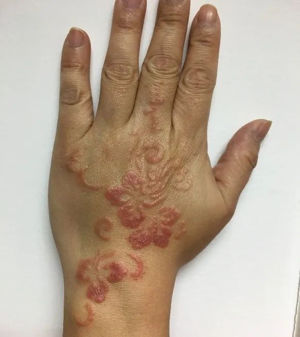 纹身",致敏的背后元凶针刺实验或血液检测可以寻找吸入性和食入性过敏