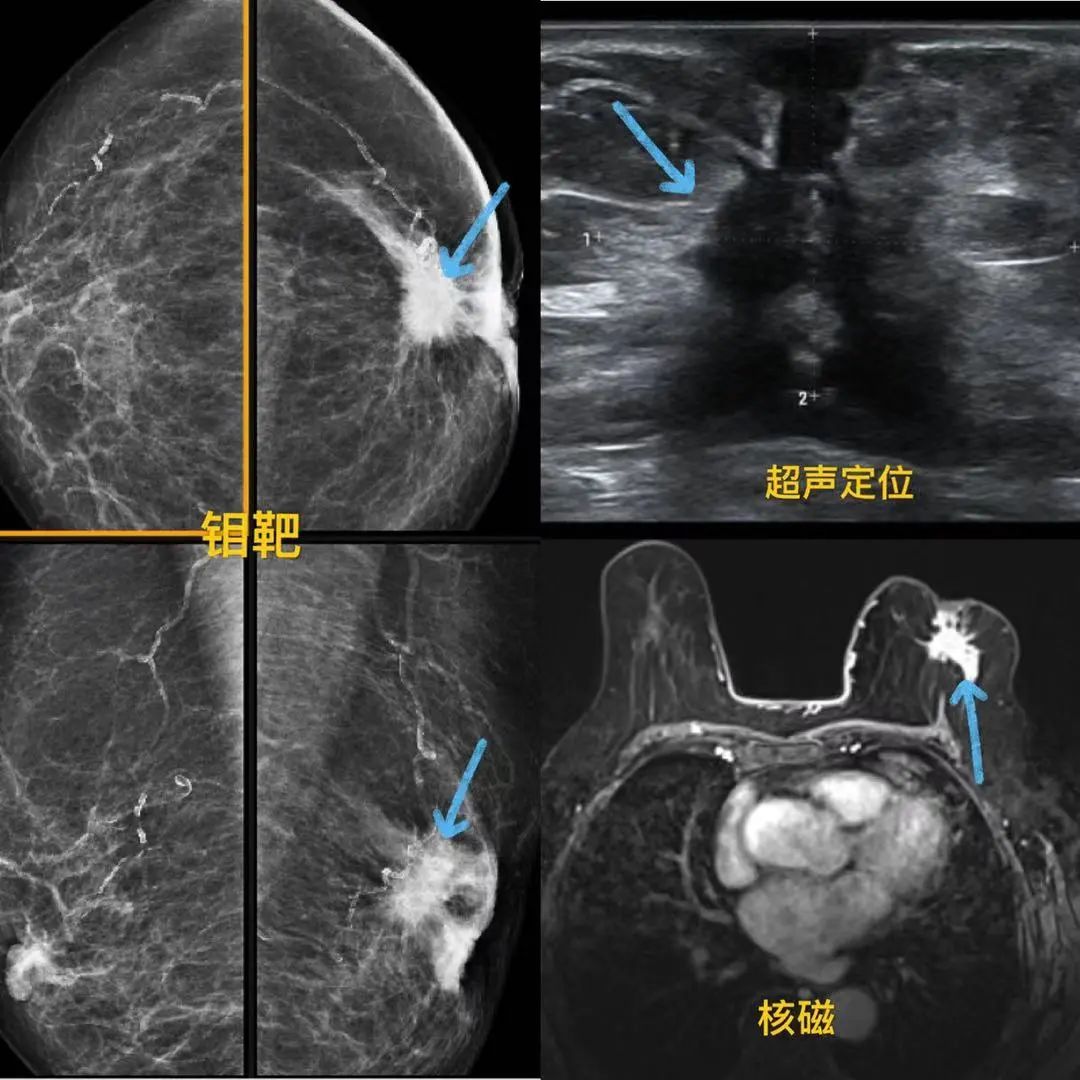 乳腺癌磁共振图片图片