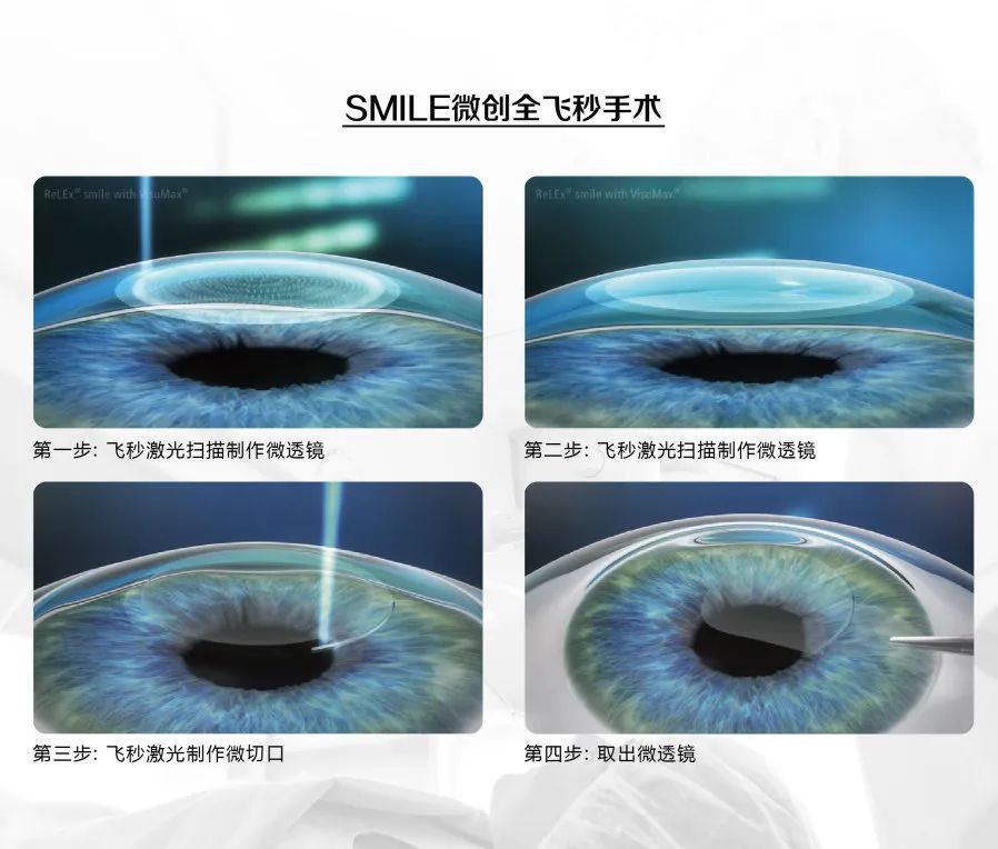 什么是全飞秒激光手术?