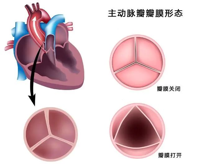 主动脉瓣左冠瓣图片