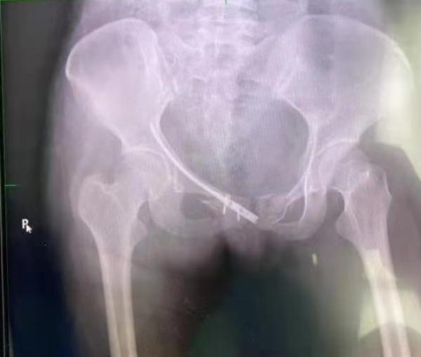 黄豆大的切口 一枚髓内钉成功治疗耻骨骨折 澎湃新闻 The Paper