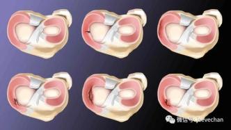 半月板撕裂别流泪，眼泪擦干看这里