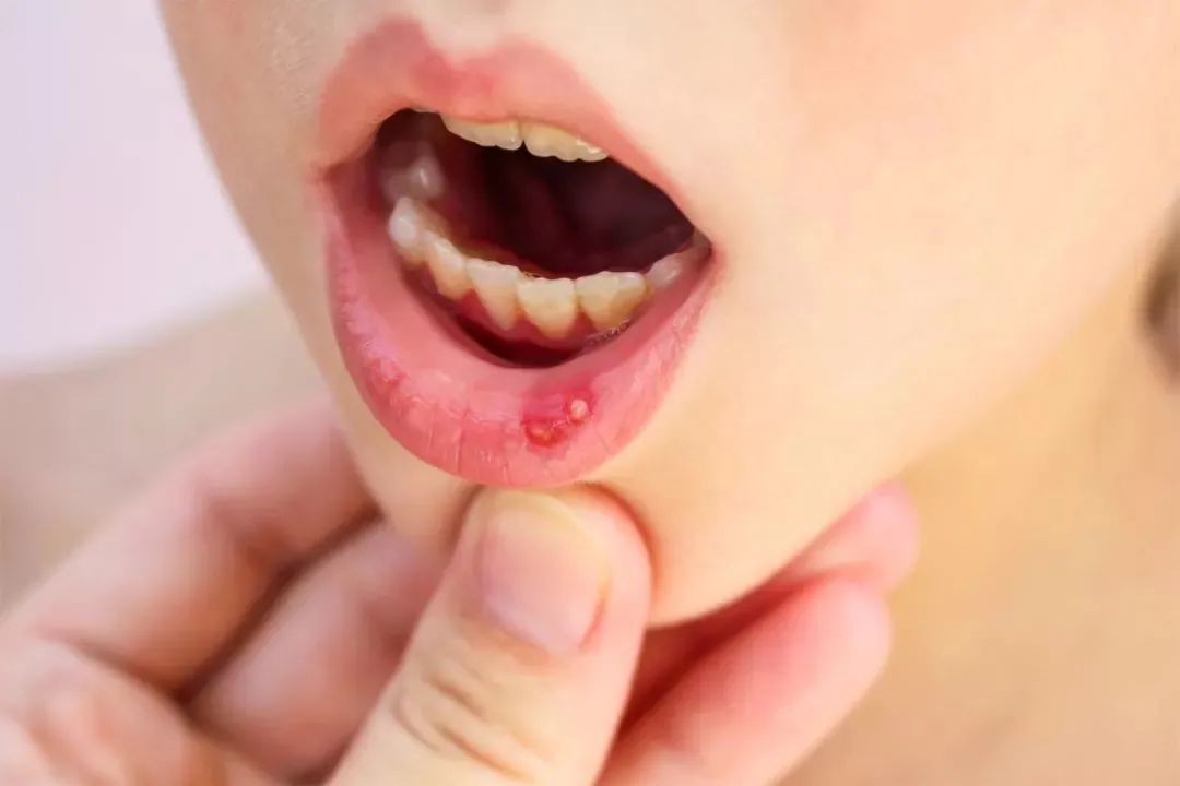 口腔溃疡,以齿龈,舌体,两颊,上颚等处出现黄白色溃疡,疼痛流口水,或