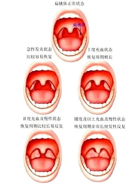 孩子扁桃体反复发炎怎么办