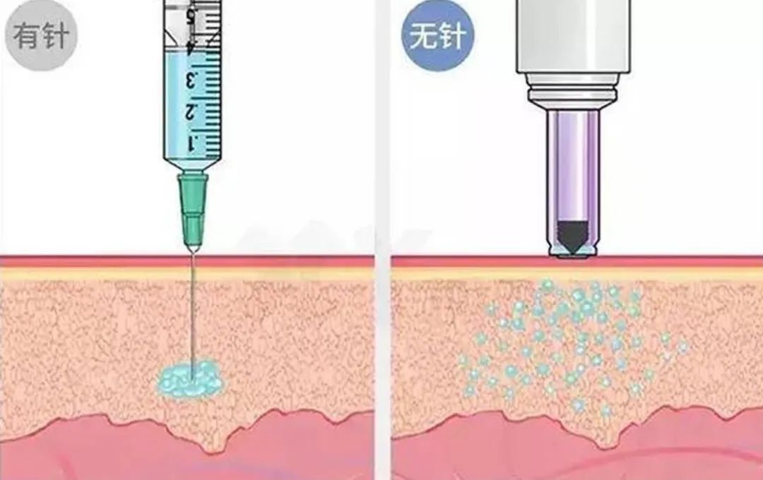 科普广州如果说微针贴片还不能算真的无针头,那射流注射就是让注射器