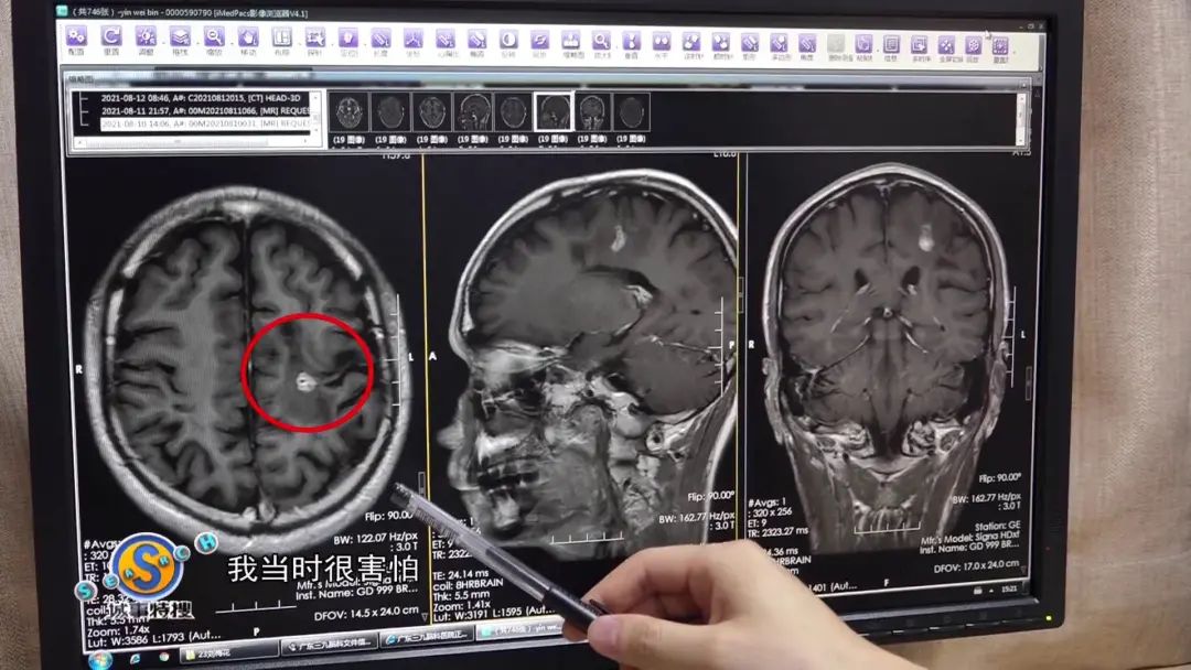 经过医院检查发现,王先生颅内可能长了"裂头蚴".