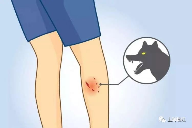 被狗咬了 来这里打狂犬疫苗 24小时接诊