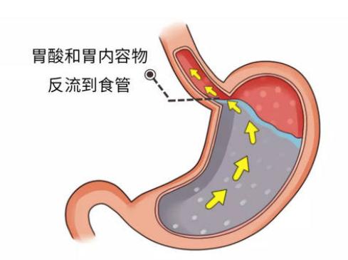 是什么原因引起胃食管反流 103.jpg