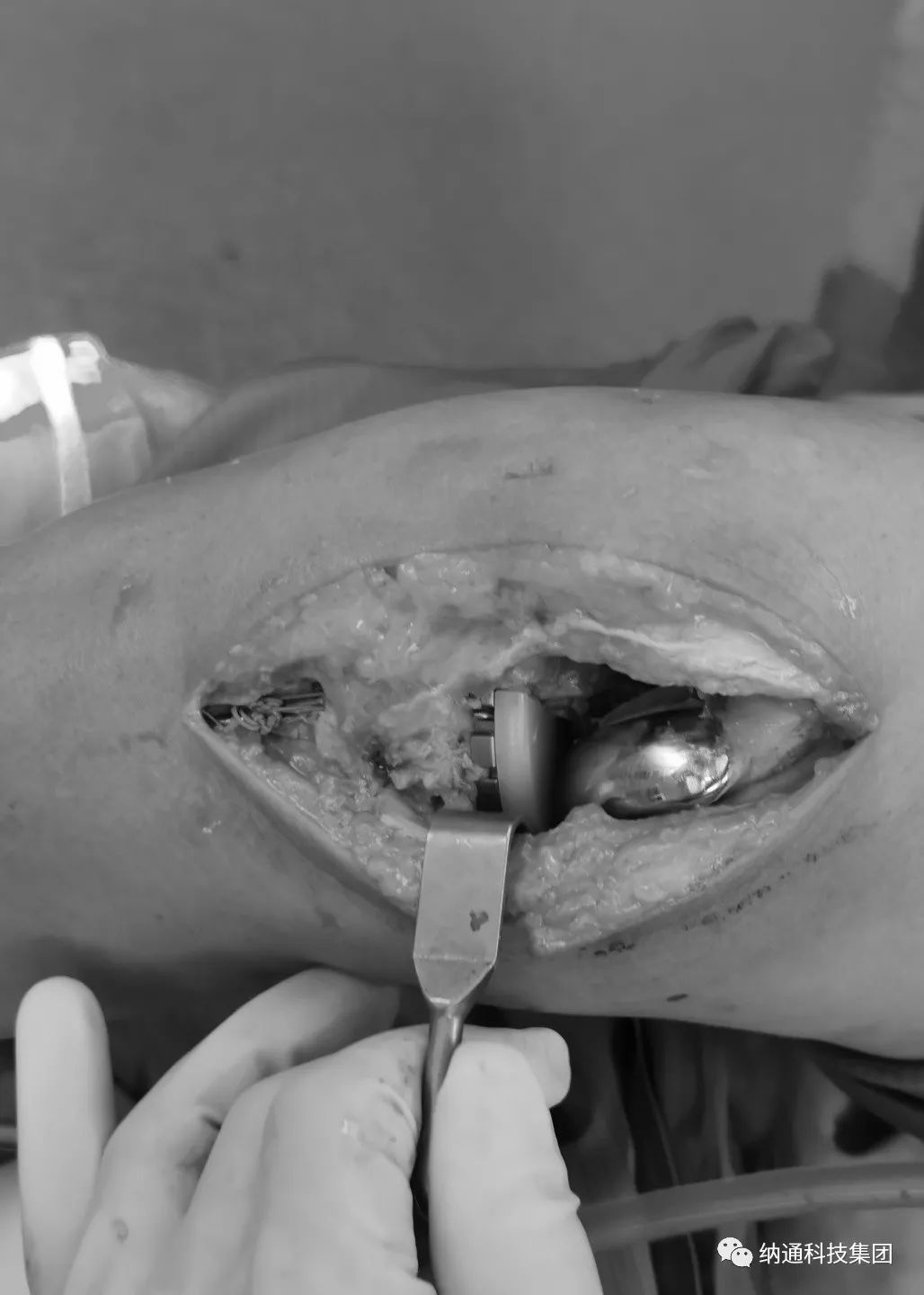 综合分析患者疼痛原因,诊断是前交叉韧带受损,内侧间隙狭窄,半月板