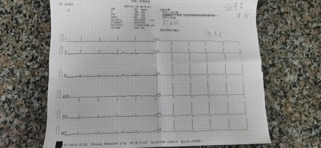 心绞痛发作典型心电图图片