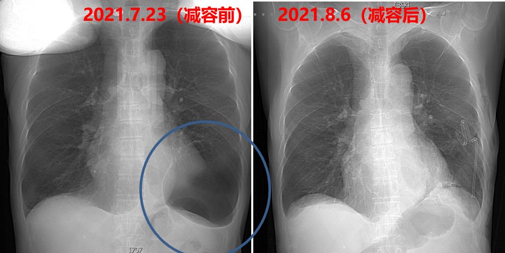 肺大泡x线胸片图解图片