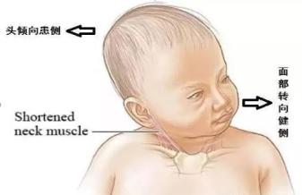 新生儿小下颌畸形图片