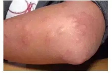 这种叫蠓的小飞虫能把你咬到懵圈防治锦囊收好不谢