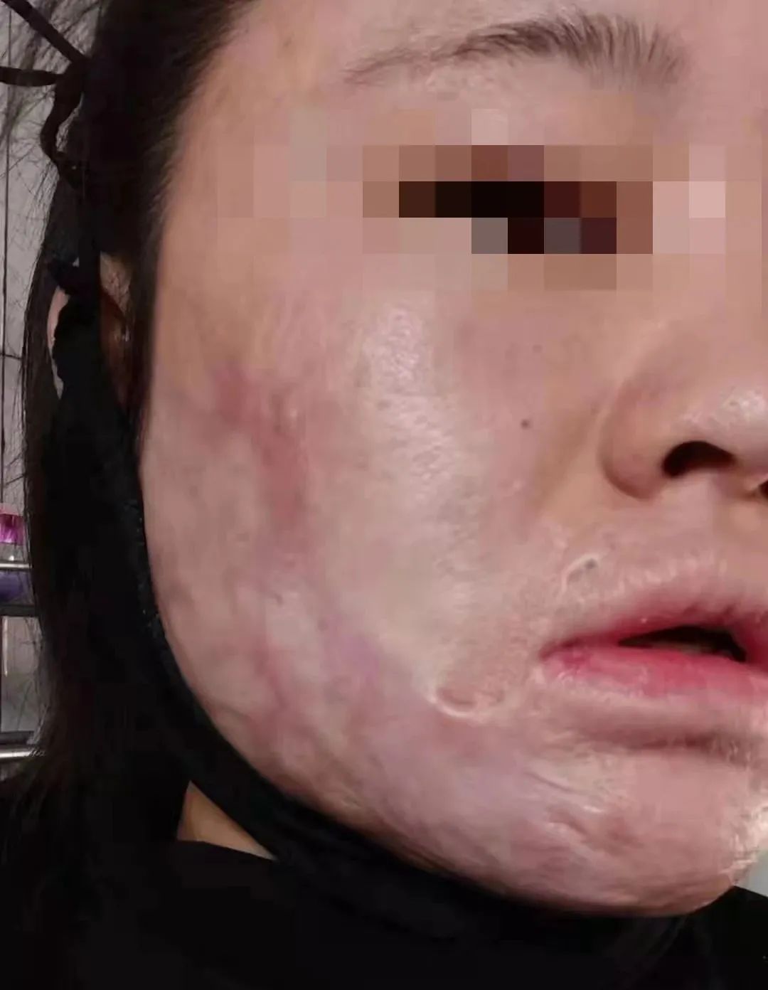 云南疤痕治疗救助中心成立富源一烧伤女孩成首例公益援助对象