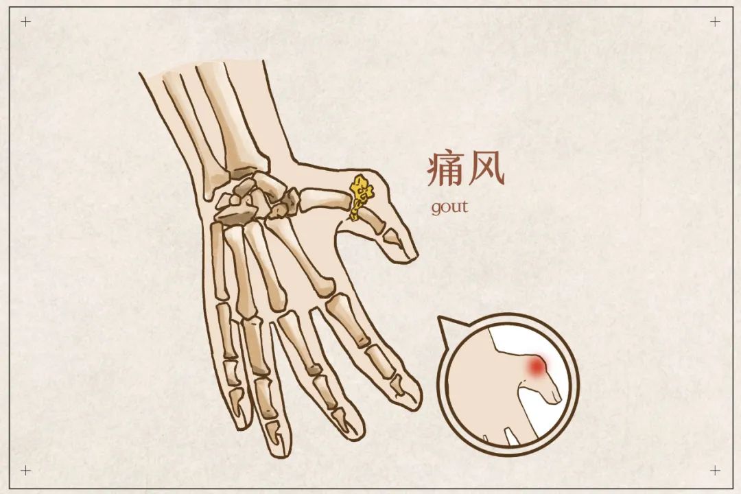 为什么痛风性关节炎越来越多偷袭年轻人